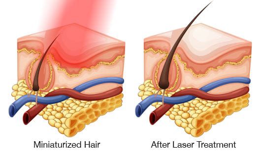 Low level Laser Light Therapy Low level Laser Light Therapy