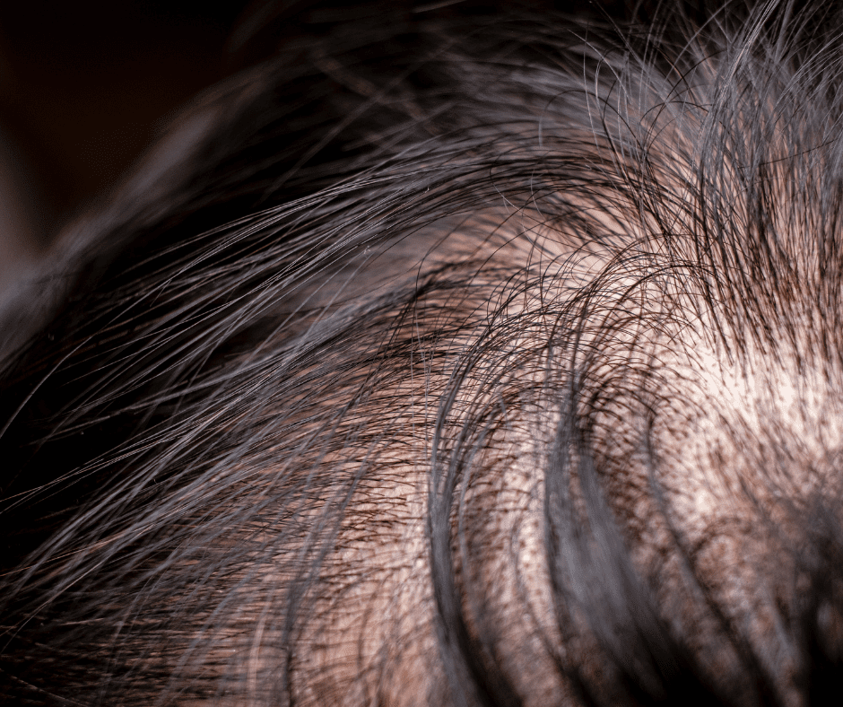 Hair Loss
