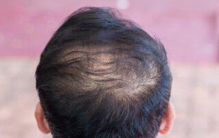 The Real Impact of Hair Loss on Men of All Ages: A New Dawn with Bond Studio NYC